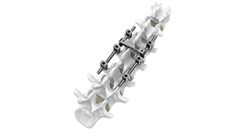 MS - I Spinal Fixation System