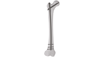 Advanced Proximal Femoral Nail Antirotation (APFAN)