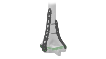 Distal Humerus Plate (Elbow)