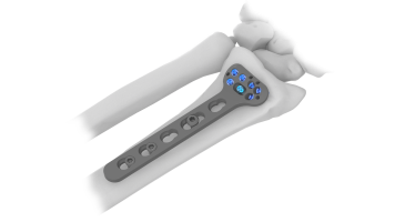 Volar Plate Distal Radius System (ASLP)