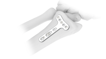 Dorsal And Volar Plate 2.4 System (ASLP)