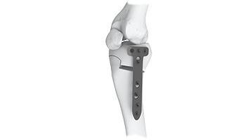 High Tibia Osteotomy (HTO) System