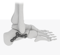 Foot and Ankle Trauma Implants