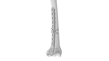 VALP 4.5/5.0 Curved Condylar Plate