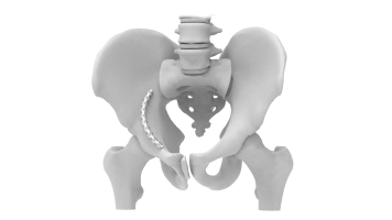 Pelvic Plating System