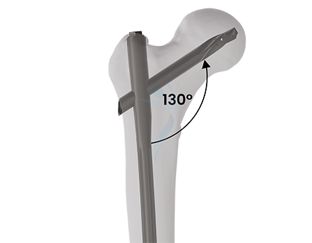 Anatomic 130° Neck-Shaft Angle (CCD) for optimal alignment and load distribution