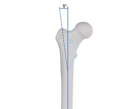 Anatomical 5° lateral angle for accurate entry and improved alignment