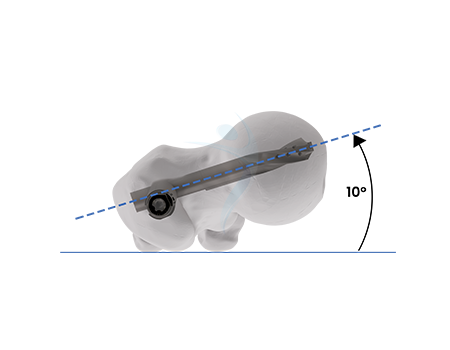 Anatomic 10° anteversion to facilitate optimal implant positioning
