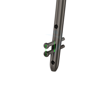 Dynamic interlocking, enabling controlled dynamization of up to 10mm