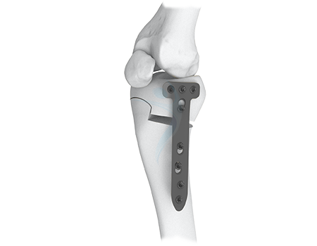 Proximal Tibia Plate System (ASLP)