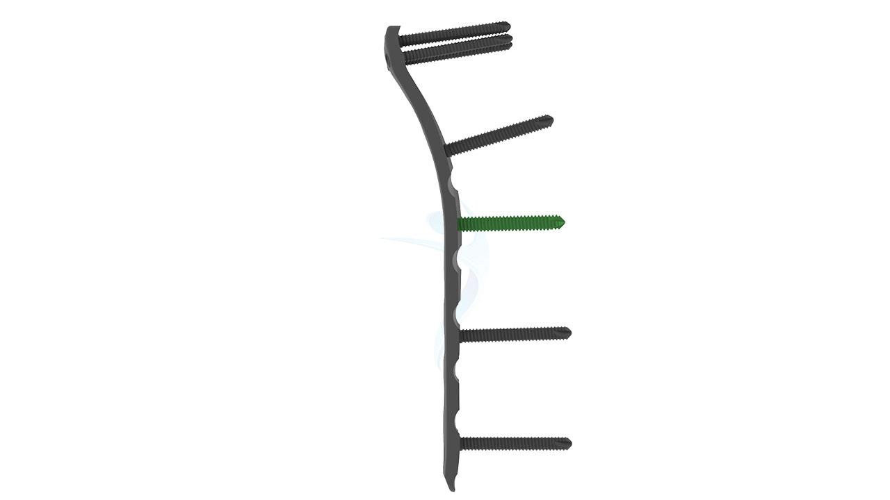 2.7 mm Medial Elbow Plate - ASLP
