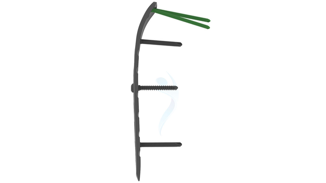 3.5 mm Distal Humerus Posterolateral Without Support Plate ASLP