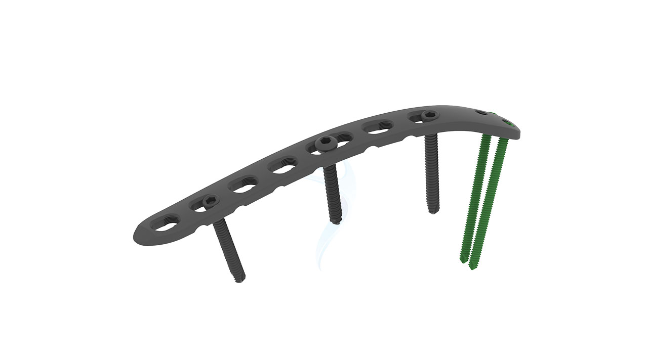 2.7 3.5 mm Locking Posterolateral Without Lateral Support Plate ASLP