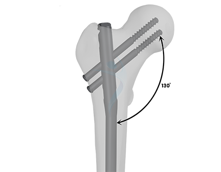 Expert Femur Nail II - Proximal Recon Locking