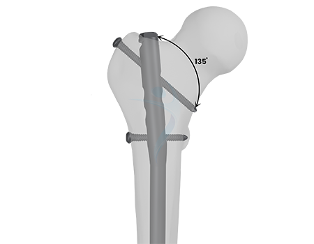 Proximal Locking Static Expert Femur Nail -II