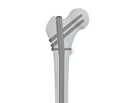 Recon Locking With Transverse Locking Screw EFN-II