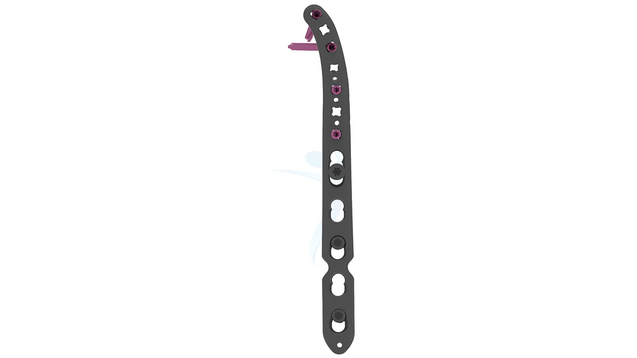 2.7 3.5 Locking Lateral Distal Humerus Plate
