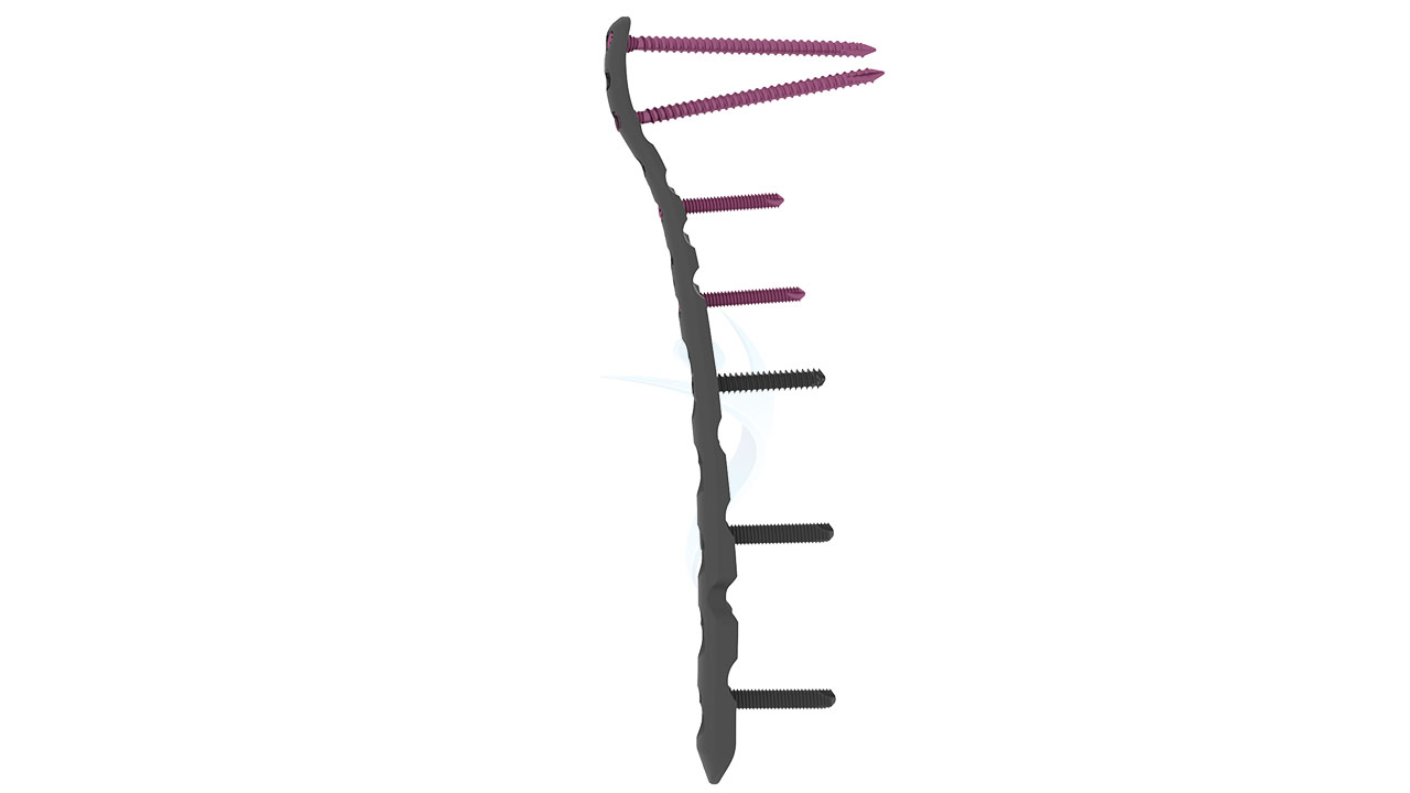 Variable Locking Lateral Distal Humerus Plate