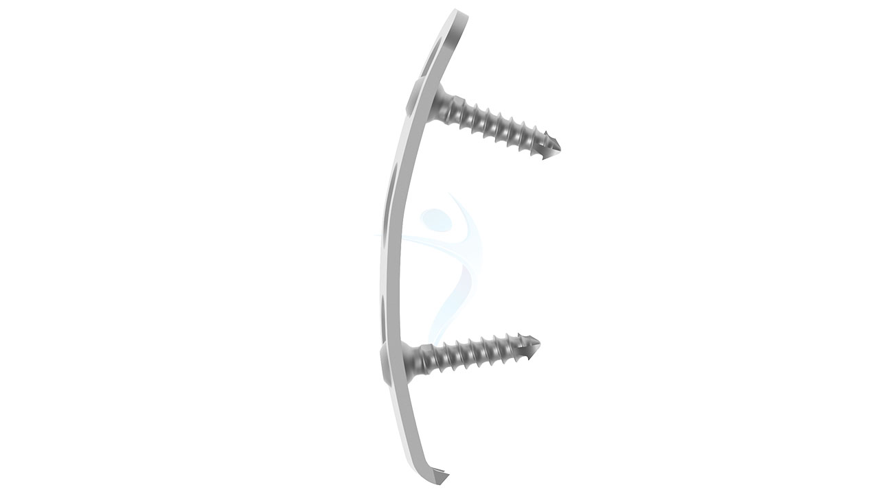 Reconstruction Pelvic Spring Plate