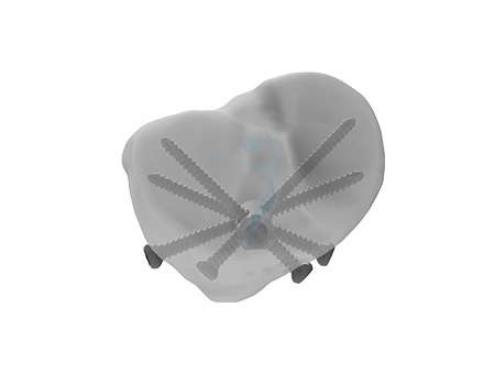 Multi Proximal Locking Hole (Suprapatellar Ml Nail)