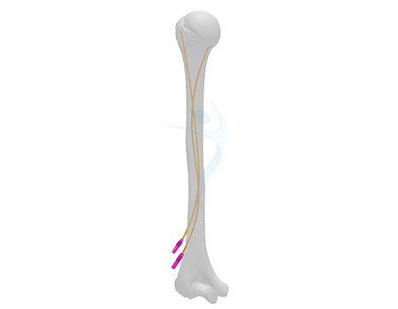 Cannulated Adolescent Lateral Entry Femoral Nail Titanium | Products |  DePuy Synthes