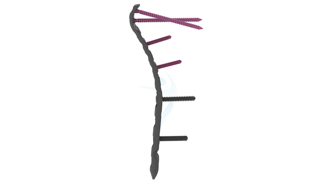 Distal Humerus Elbow VALP Medial Plate - 2.7 / 3.5 mm