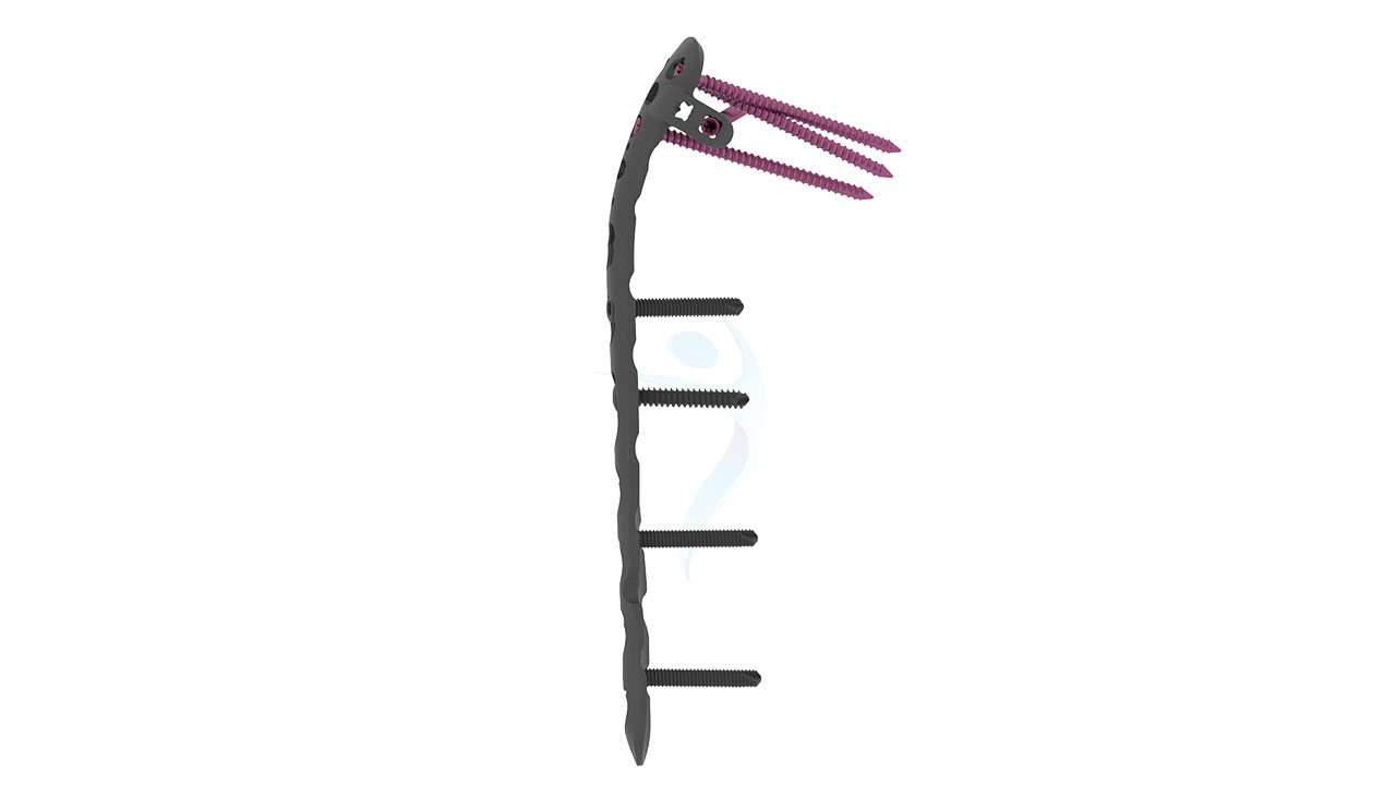 Distal Humerus Posterolateral With Support Plate 2.7 3.5 mm