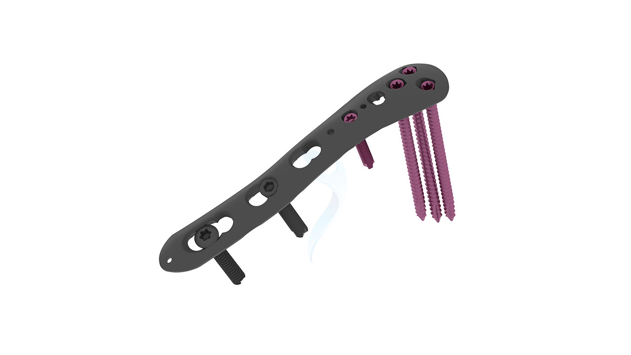 2.7 3.5 mm Locking Posterolateral Without Lateral Support Plate