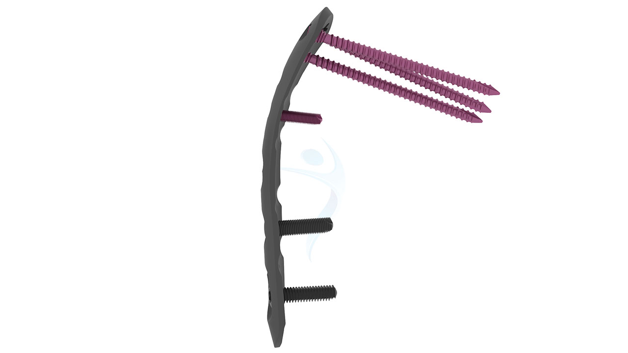 3.5 mm Distal Humerus Posterolateral Without Support Plate VALP